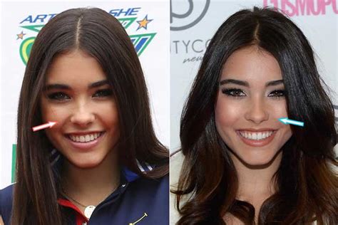 Madison Beer plastic surgery: Breast Implants,Before。